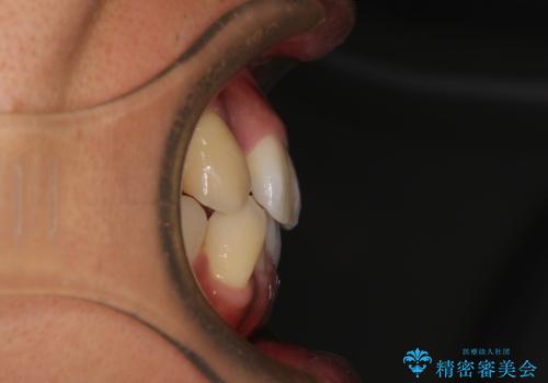 八重歯と前歯のガタガタを抜歯矯正で治療|クリアブラケット使用例の治療前