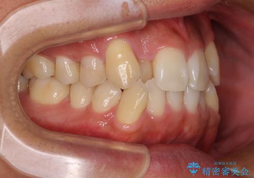 八重歯と前歯のガタガタを抜歯矯正で治療|クリアブラケット使用例の治療前