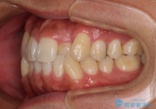 八重歯と前歯のガタガタを抜歯矯正で治療|クリアブラケット使用例の治療前