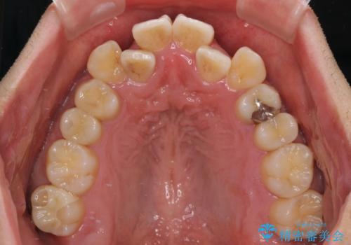 八重歯と前歯のガタガタを抜歯矯正で治療|クリアブラケット使用例の治療前