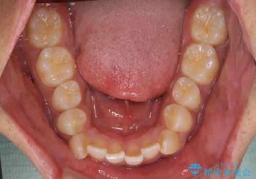 八重歯と前歯のガタガタを抜歯矯正で治療|クリアブラケット使用例の治療前