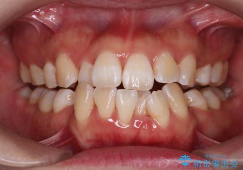 重度のデコボコも、インビザラインで改善の治療中