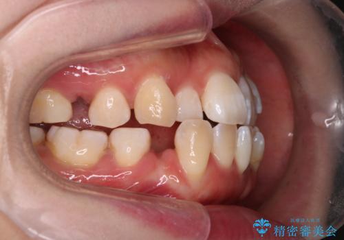 重度のデコボコも、インビザラインで改善の治療中