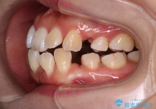 重度のデコボコも、インビザラインで改善の治療中