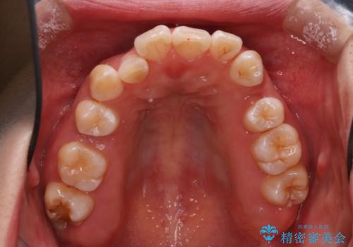 重度のデコボコも、インビザラインで改善の治療中