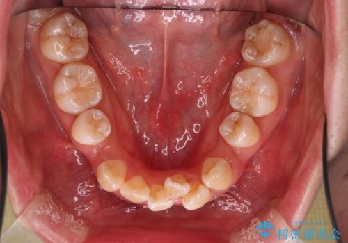 重度のデコボコも、インビザラインで改善の治療中