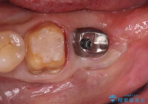 エンドペリオ病変と虫歯を同時に改善したインプラント・セラミック治療症例の治療中