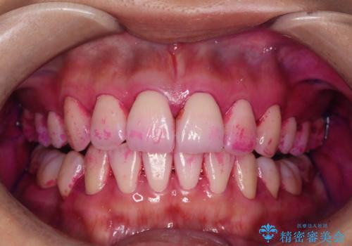 メンテナンスで日々のブラッシングの再確認の治療前