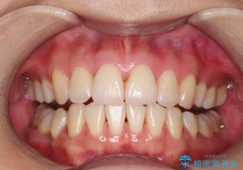 メンテナンスで日々のブラッシングの再確認の治療後