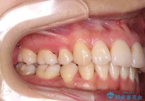 メンテナンスで日々のブラッシングの再確認の症例 治療後