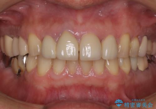 前歯の被せ物をリニューアルの治療前