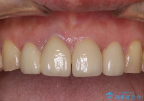 前歯の被せ物をリニューアルの治療前