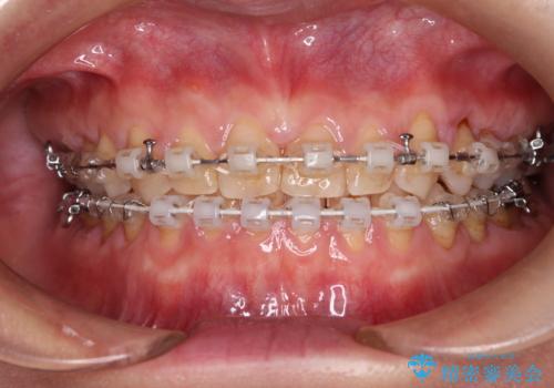 【審美装置】すきっ歯をワイヤー装置で治したいの治療中