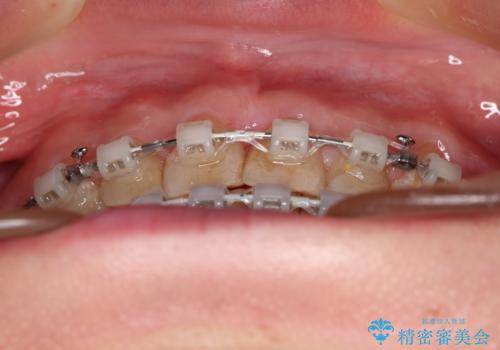 【審美装置】すきっ歯をワイヤー装置で治したいの治療中