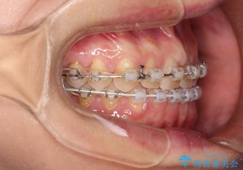 【審美装置】すきっ歯をワイヤー装置で治したいの治療中