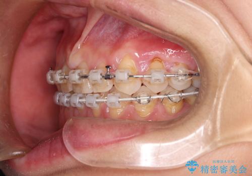 【審美装置】すきっ歯をワイヤー装置で治したいの治療中