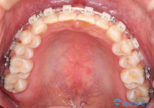 【審美装置】すきっ歯をワイヤー装置で治したいの治療中