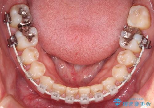 【審美装置】すきっ歯をワイヤー装置で治したいの治療中