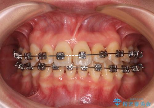 【モニター】前歯のデコボコをワイヤーの抜歯矯正で綺麗に整えるの治療中