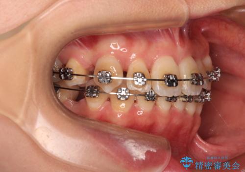 【モニター】前歯のデコボコをワイヤーの抜歯矯正で綺麗に整えるの治療中