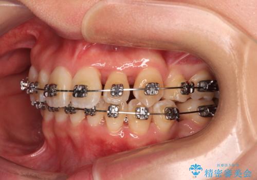 【モニター】前歯のデコボコをワイヤーの抜歯矯正で綺麗に整えるの治療中