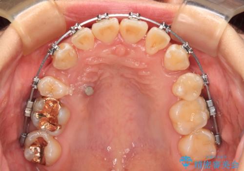 【モニター】前歯のデコボコをワイヤーの抜歯矯正で綺麗に整えるの治療中