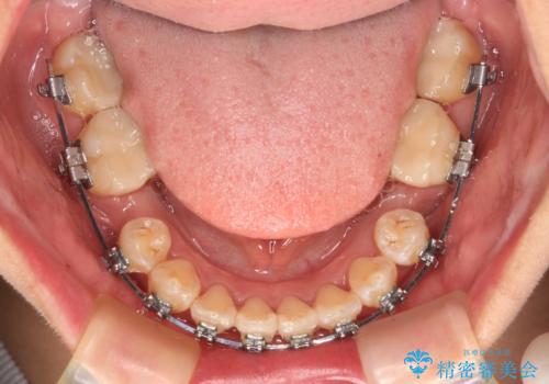 【モニター】前歯のデコボコをワイヤーの抜歯矯正で綺麗に整えるの治療中