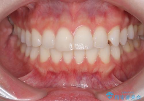 左の八重歯を、目立たないマウスピース矯正で改善の症例 治療前