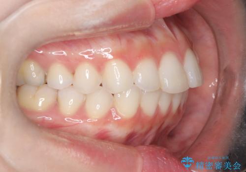 左の八重歯を、目立たないマウスピース矯正で改善の治療前