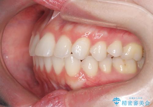 左の八重歯を、目立たないマウスピース矯正で改善の治療前
