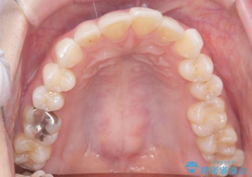 左の八重歯を、目立たないマウスピース矯正で改善の治療前