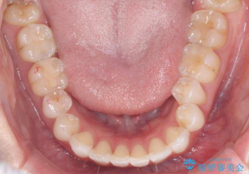 左の八重歯を、目立たないマウスピース矯正で改善の治療前