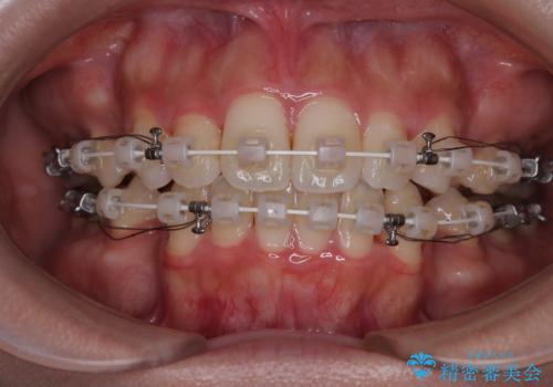 横顔の印象を改善したい ワイヤー装置での抜歯矯正の治療中