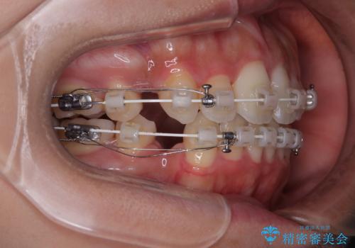 横顔の印象を改善したい ワイヤー装置での抜歯矯正の治療中