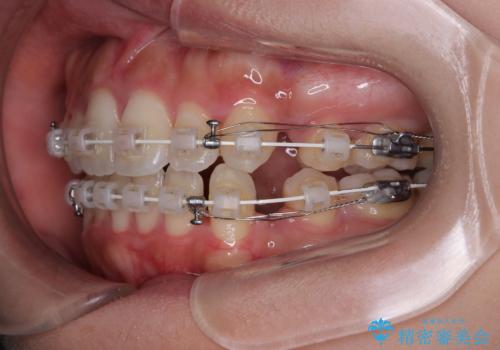 横顔の印象を改善したい ワイヤー装置での抜歯矯正の治療中