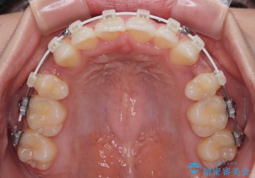 横顔の印象を改善したい ワイヤー装置での抜歯矯正の治療中