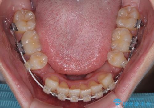 横顔の印象を改善したい ワイヤー装置での抜歯矯正の治療中