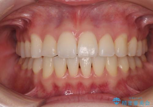 前歯のデコボコと口元の膨らみを治したい ワイヤー装置での非抜歯矯正の症例 治療後