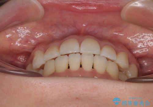 前歯のデコボコと口元の膨らみを治したい ワイヤー装置での非抜歯矯正の治療後