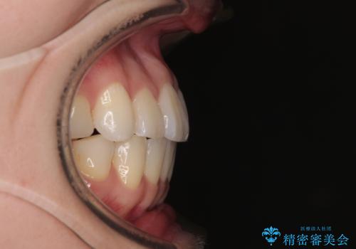 前歯のデコボコと口元の膨らみを治したい ワイヤー装置での非抜歯矯正の治療後