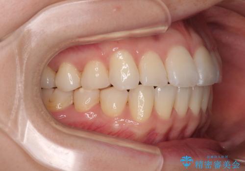 前歯のデコボコと口元の膨らみを治したい ワイヤー装置での非抜歯矯正の治療後