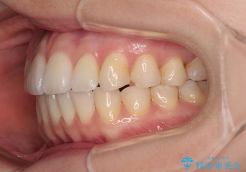 前歯のデコボコと口元の膨らみを治したい ワイヤー装置での非抜歯矯正の治療後