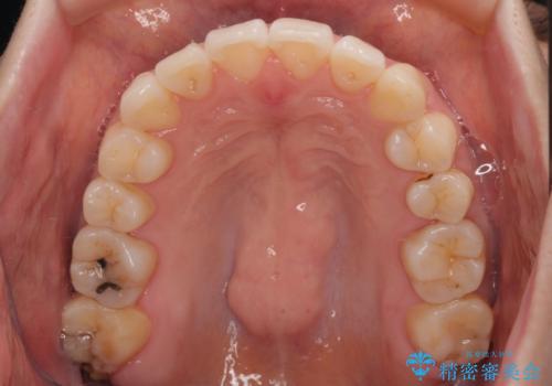 前歯のデコボコと口元の膨らみを治したい ワイヤー装置での非抜歯矯正の治療後