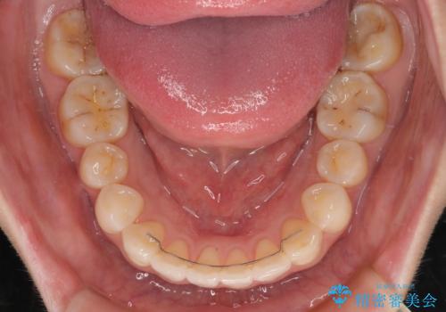 前歯のデコボコと口元の膨らみを治したい ワイヤー装置での非抜歯矯正の治療後