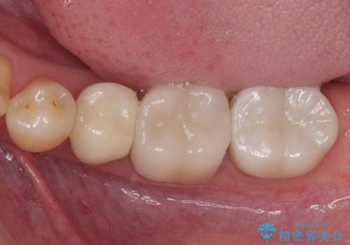 気になる奥歯のむし歯治療の治療後