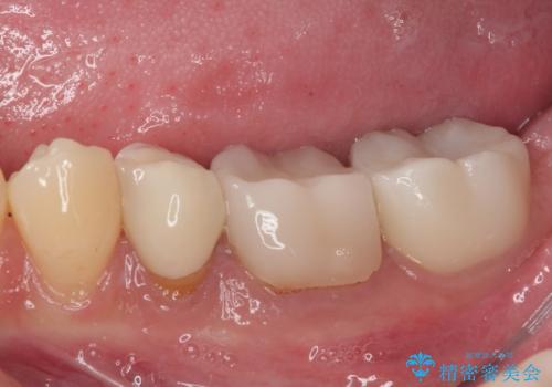 気になる奥歯のむし歯治療の治療後