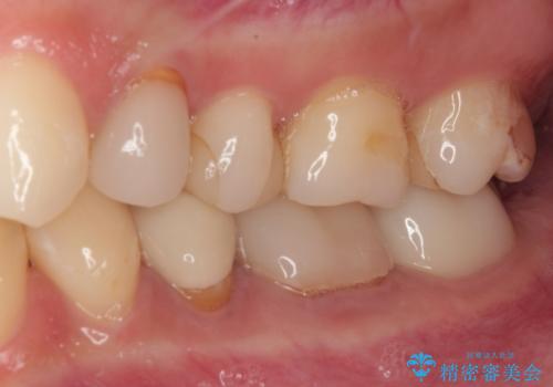 気になる奥歯のむし歯治療の治療後