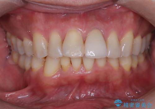 男性のエアーフローとオフィスホワイトニングの症例 治療前