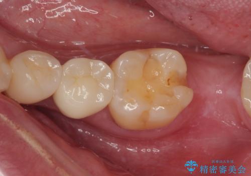 詰め物が外れかけてるのでやり替えたい セラミックインレー修復・フルジルコニアクラウンの症例 治療後