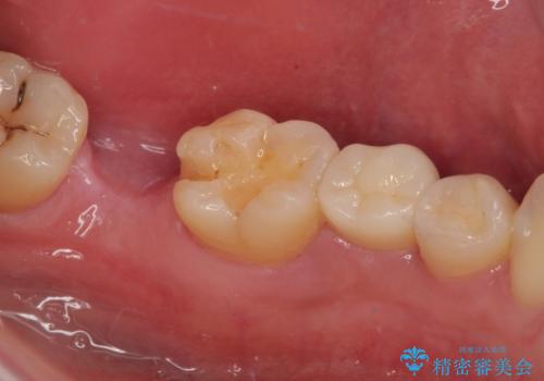 詰め物が外れかけてるのでやり替えたい セラミックインレー修復・フルジルコニアクラウンの治療後